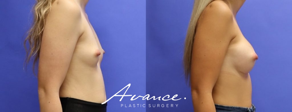 Before and After - Breast Augmentation