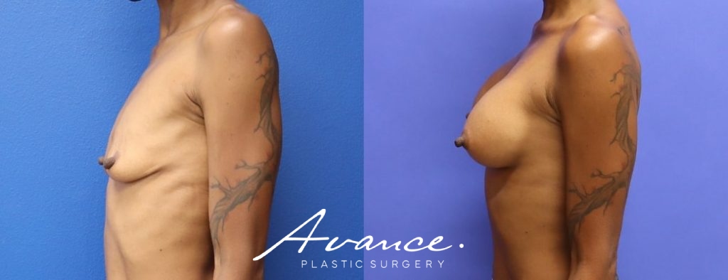 Before and After - Breast Augmentation