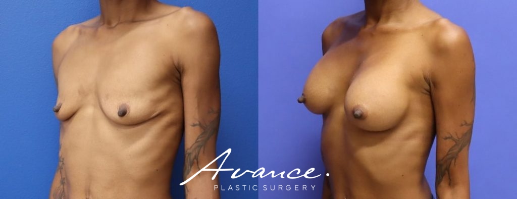Before and After - Breast Augmentation
