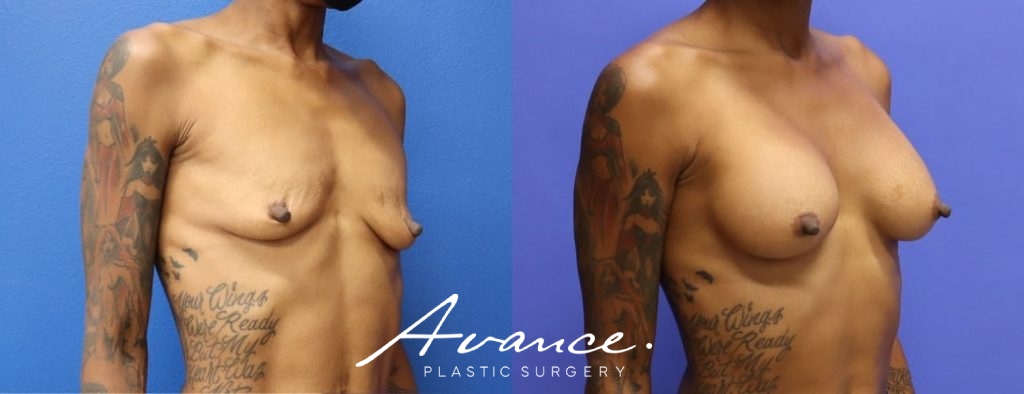 Before and After - Breast Augmentation
