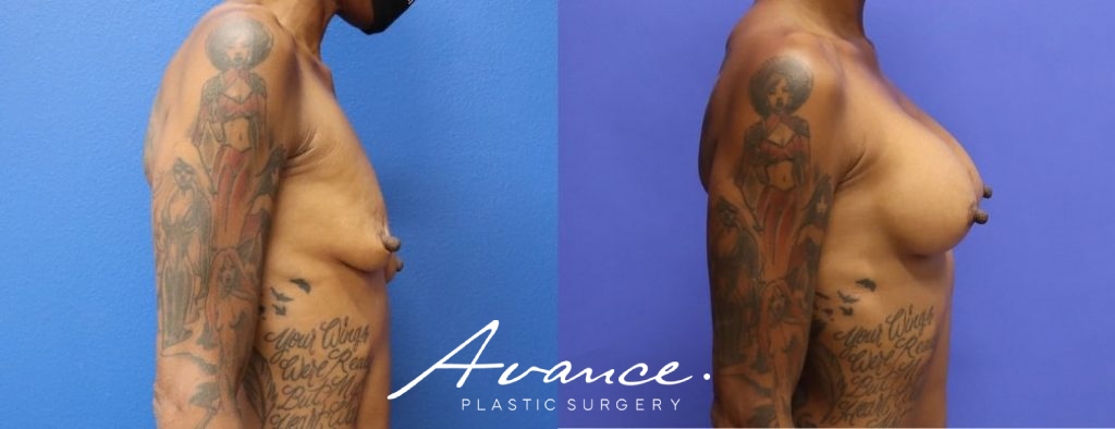 Before and After - Breast Augmentation