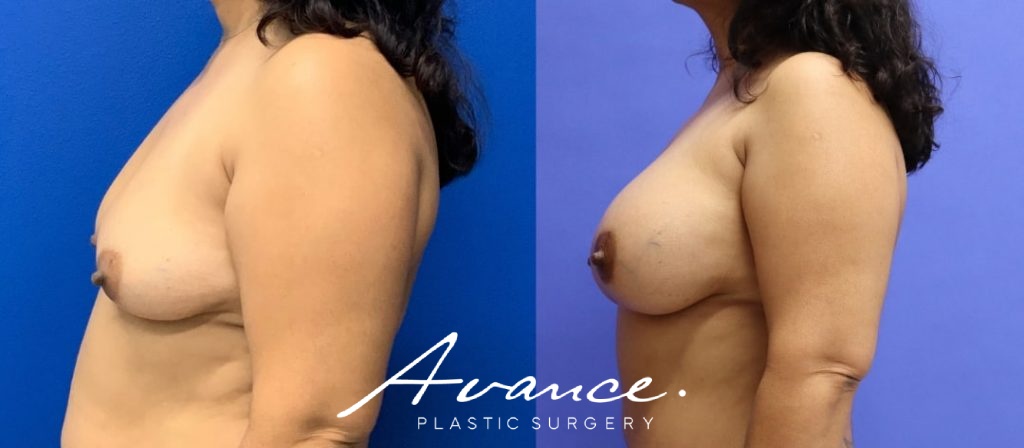 Before and After - Breast Augmentation