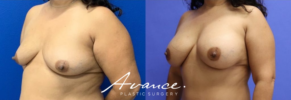 Before and After - Breast Augmentation