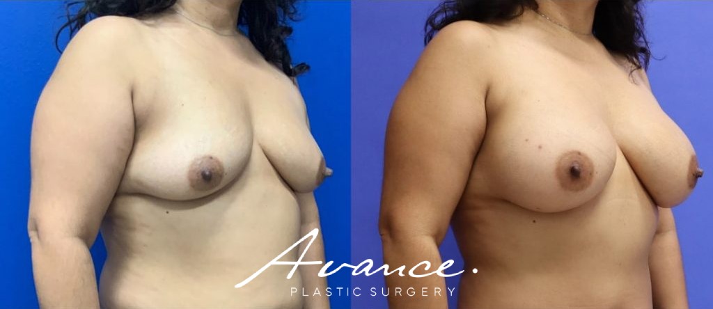 Before and After - Breast Augmentation