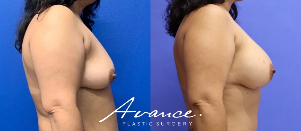 Before and After - Breast Augmentation