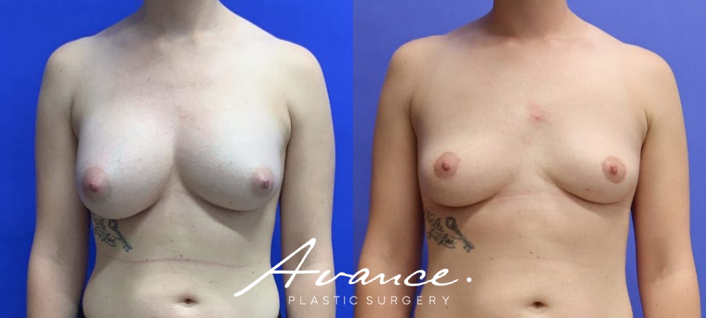 Before and After - Breast Implant Removal