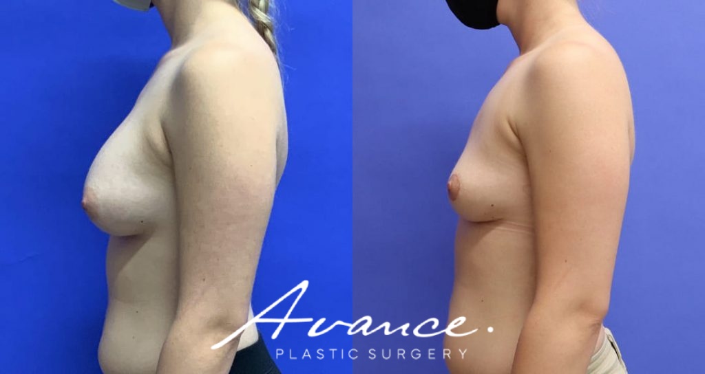 Before and After - Breast Implant Removal