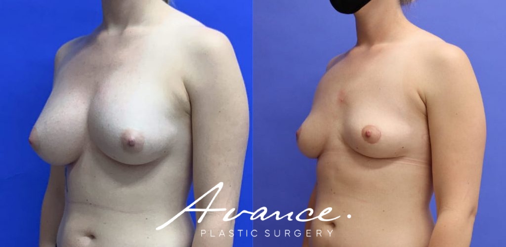 Before and After - Breast Implant Removal