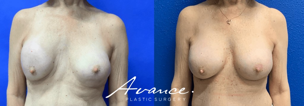 Before and After - Capsular contracture Correction