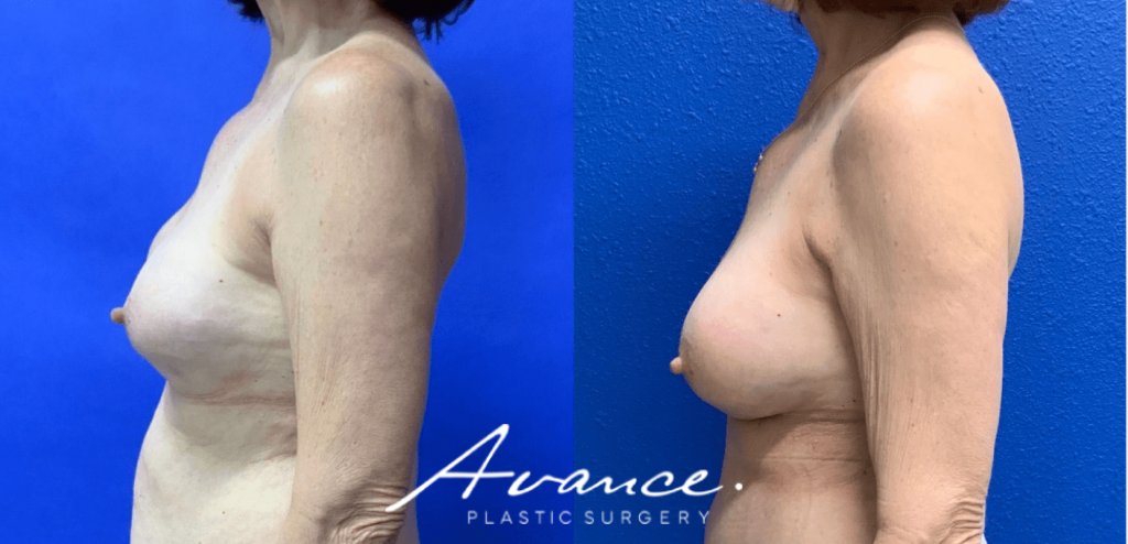 Before and After - Capsular contracture Correction