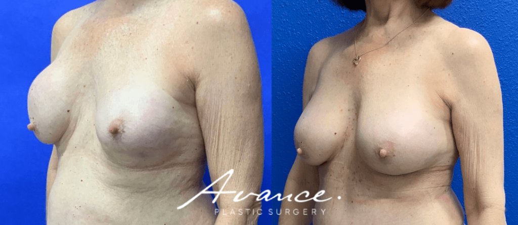 Before and After - Capsular contracture Correction