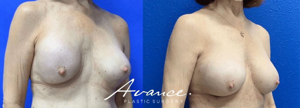 Before and After - Capsular contracture Correction