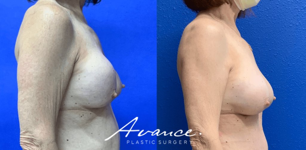 Before and After - Capsular contracture Correction