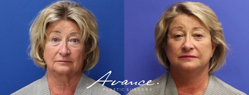 Before and After - Mini Face/Necklift