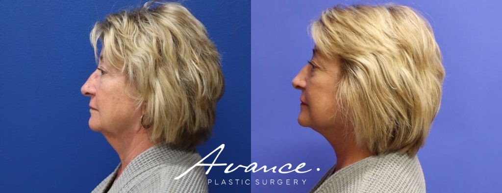 Before and After - Mini Face/Necklift