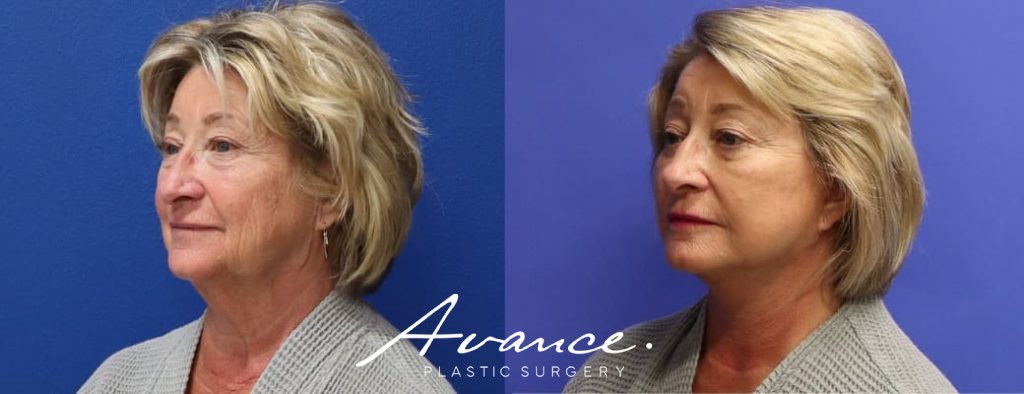 Before and After - Mini Face/Necklift