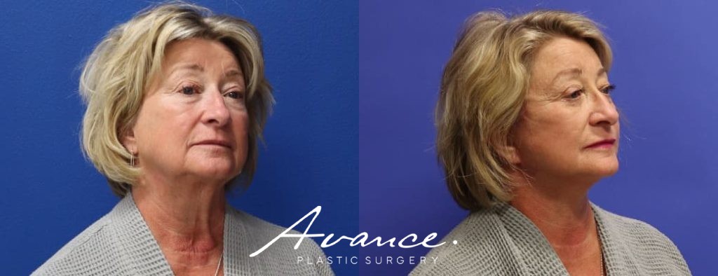Before and After - Mini Face/Necklift