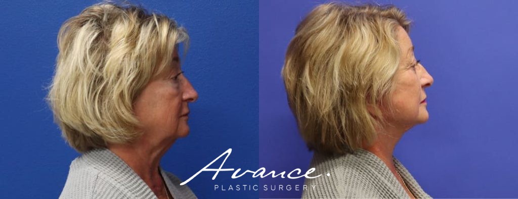 Before and After - Mini Face/Necklift
