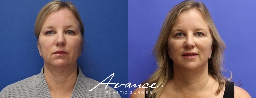 Before and After - Facelift/Necklift & Minifacelift/Necklift