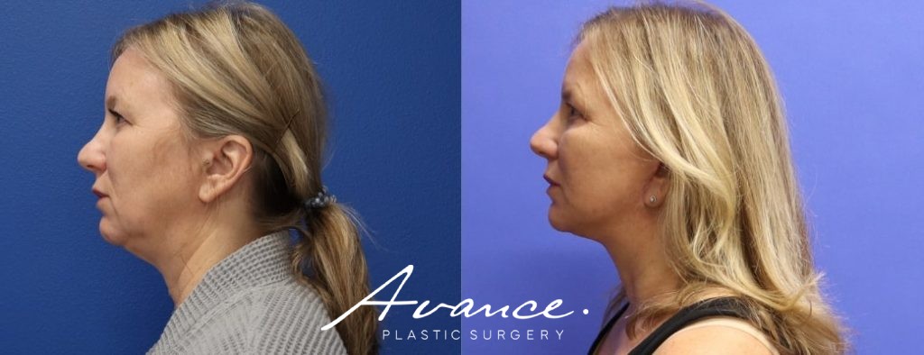 Before and After - Facelift/Necklift & Minifacelift/Necklift