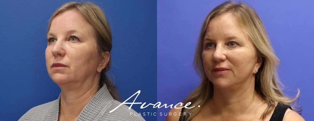 Before and After - Facelift/Necklift & Minifacelift/Necklift