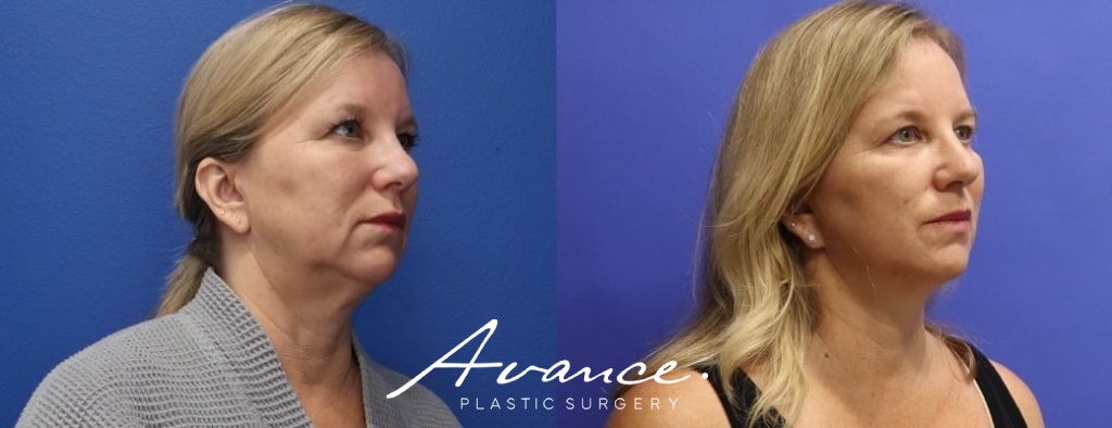 Before and After - Facelift/Necklift & Minifacelift/Necklift