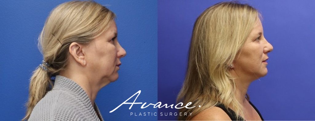 Before and After - Facelift/Necklift & Minifacelift/Necklift