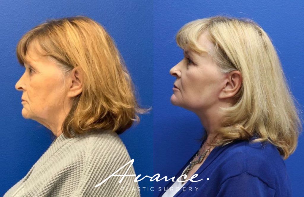 Before and After - Facelift/Necklift & Minifacelift/Necklift