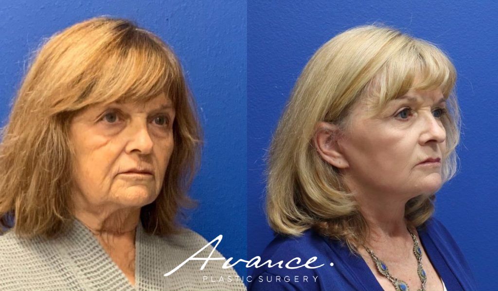 Before and After - Facelift/Necklift & Minifacelift/Necklift
