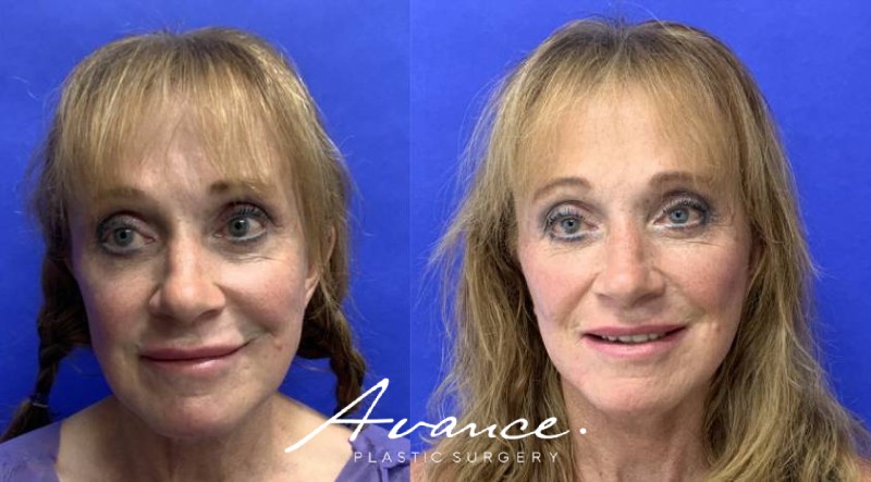 Before and After - Facelift/Necklift & Minifacelift/Necklift