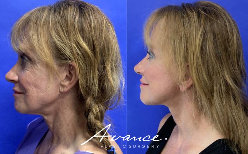Before and After - Facelift/Necklift & Minifacelift/Necklift