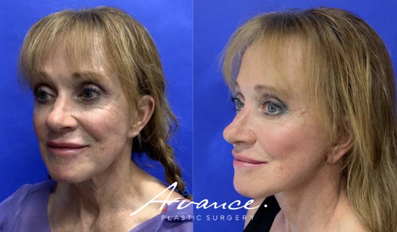 Before and After - Facelift/Necklift & Minifacelift/Necklift