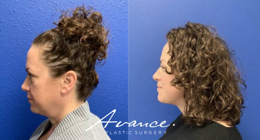 Before and After - Mini Face/Necklift