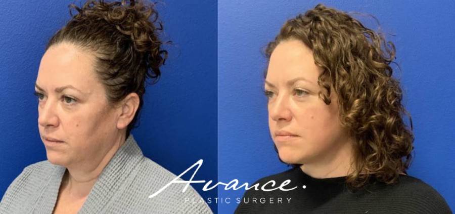 Before and After - Mini Face/Necklift