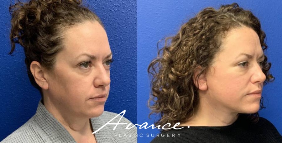 Before and After - Mini Face/Necklift