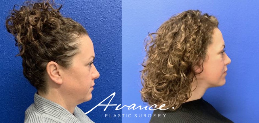 Before and After - Mini Face/Necklift