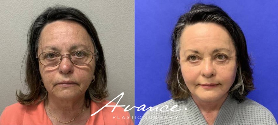 Before and After - Facelift/Necklift & Minifacelift/Necklift