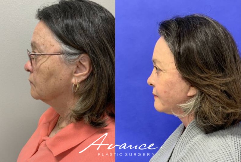 Before and After - Facelift/Necklift & Minifacelift/Necklift