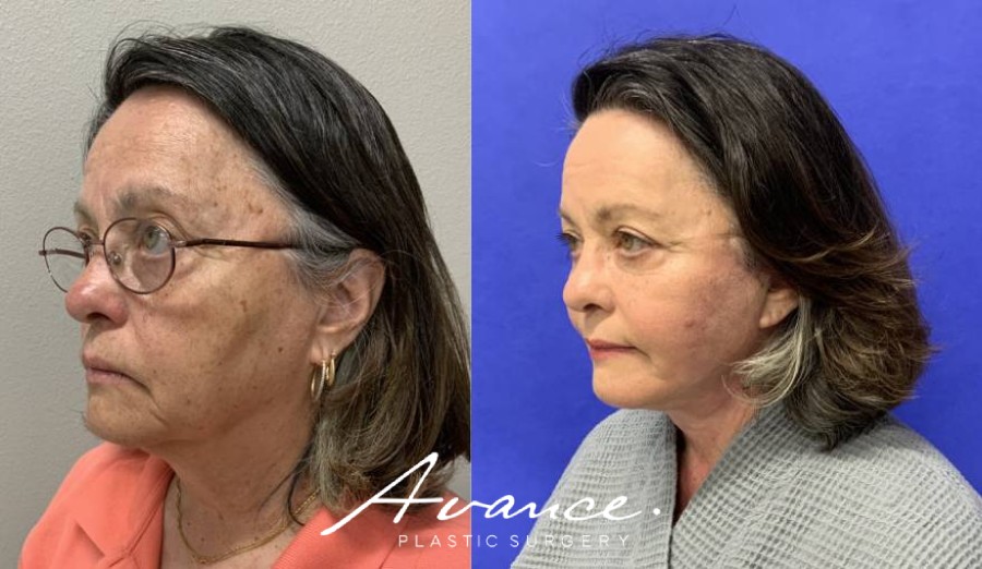 Before and After - Facelift/Necklift & Minifacelift/Necklift