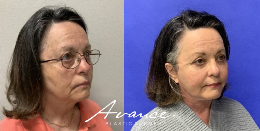 Before and After - Facelift/Necklift & Minifacelift/Necklift