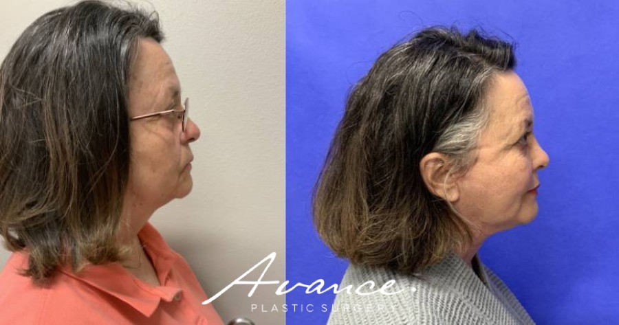 Before and After - Facelift/Necklift & Minifacelift/Necklift
