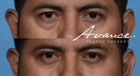 Before and After - Lower Blepheroplasty