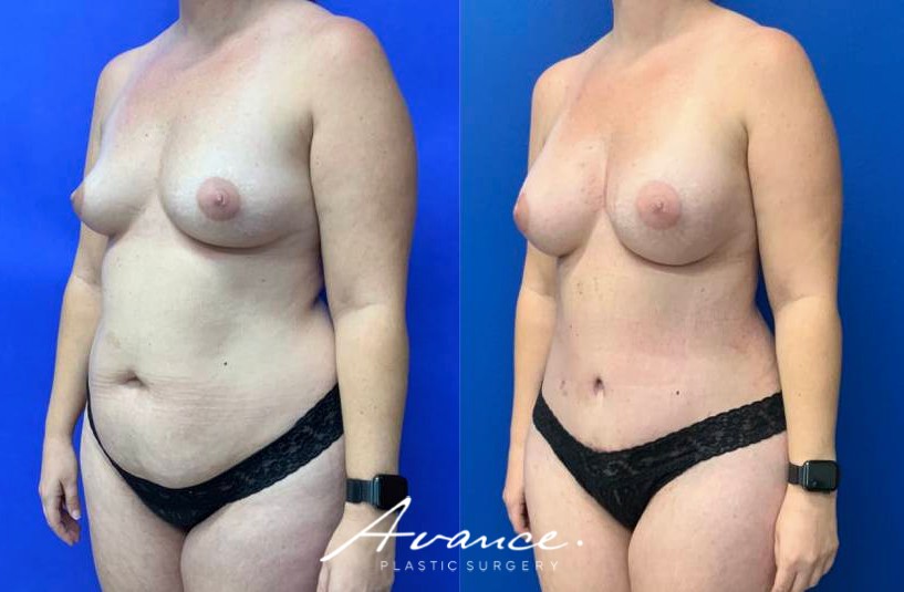 Before and After - Cambio de imagen para mamás