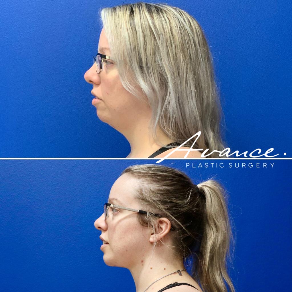 Before and After - Liposucción de cuello con radiofrecuencia FaceTite