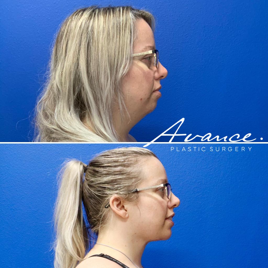 Before and After - Liposucción de cuello con radiofrecuencia FaceTite