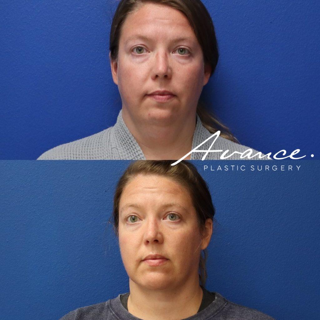 Before and After - Liposucción de cuello