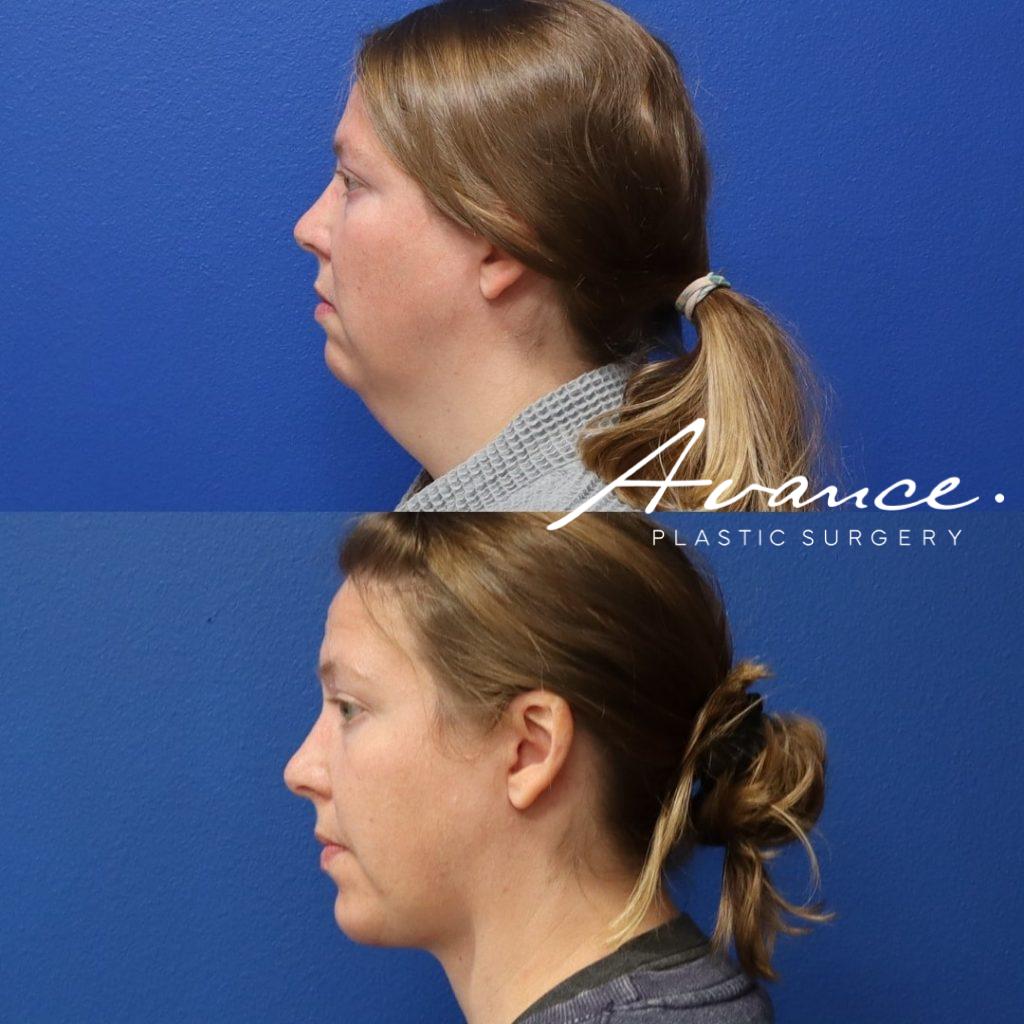Before and After - Liposucción de cuello
