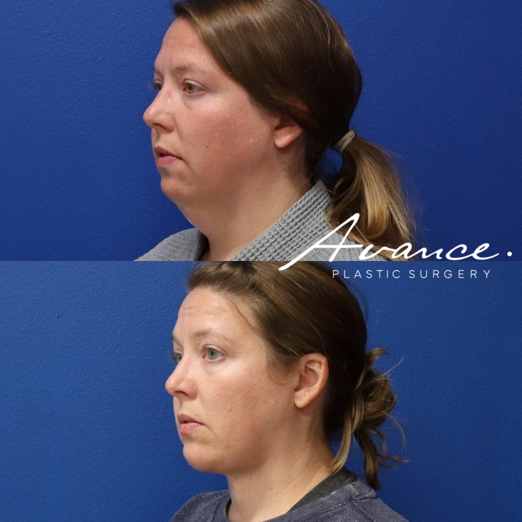 Before and After - Liposucción de cuello