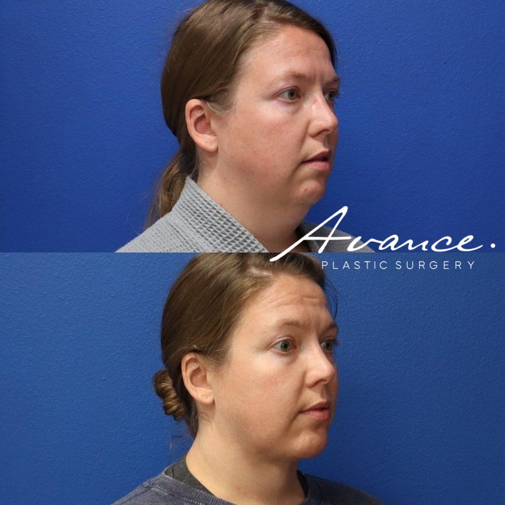 Before and After - Liposucción de cuello
