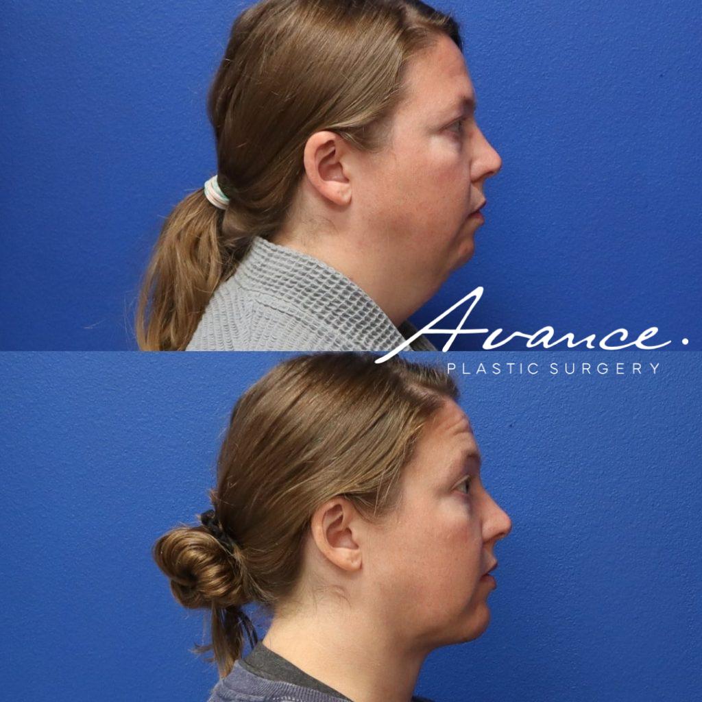 Before and After - Liposucción de cuello